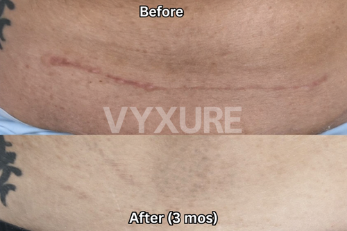Vyxure Scar Solutions Silicone Stick