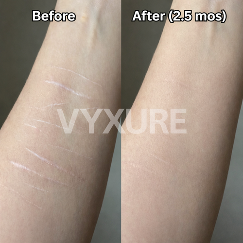 Vyxure Scar Solutions Silicone Stick