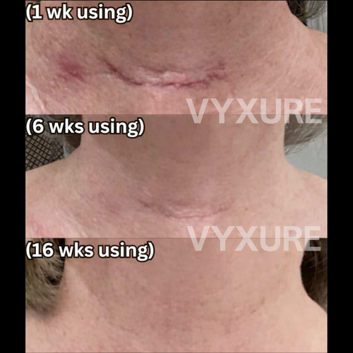 Vyxure Scar Solutions Silicone Stick