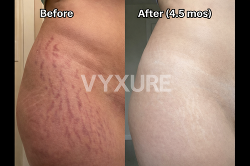 Vyxure Scar Solutions Silicone Stick